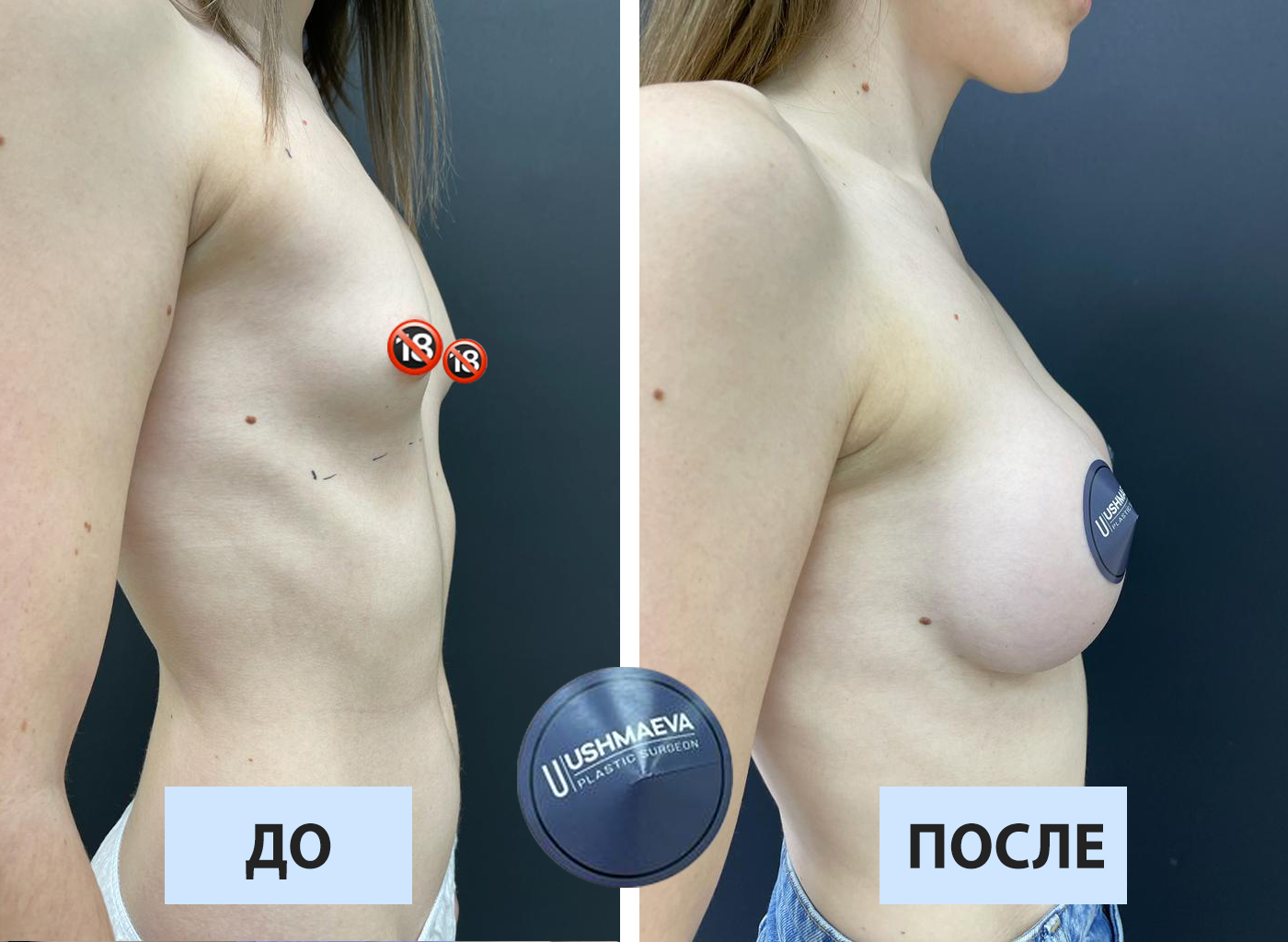 Увеличение груди имплантами